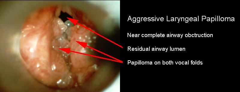 respiratory papillomatosis prognosis