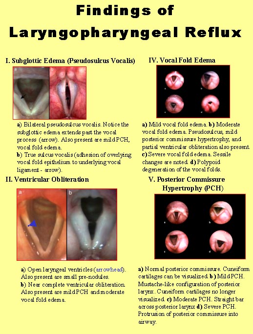 Extraesophageal Reflux Uc Davis Center For Voice And Swallowinguc Davis Center For Voice And Swallowing