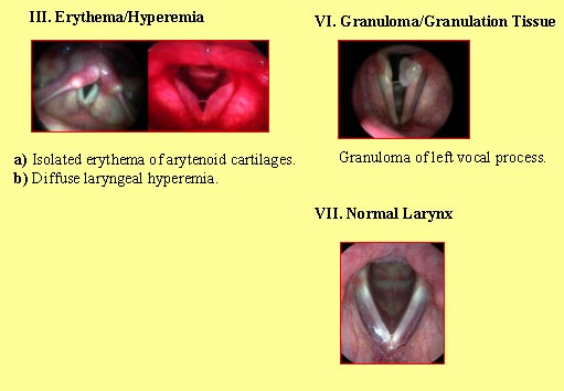 Extraesophageal Reflux Uc Davis Center For Voice And Swallowinguc Davis Center For Voice And Swallowing