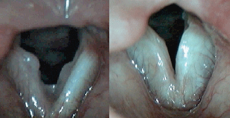 Bilateral laryngeal papillomatosis. Laryngeal papillomatosis baby.