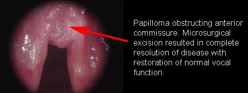 Squamous cell papilloma of larynx.