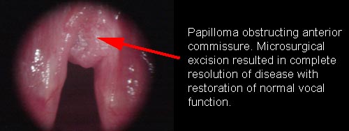 papilloma és pharyngitis