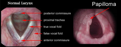 Squamous papilloma of larynx