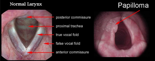 respiratory papillomatosis antiviral