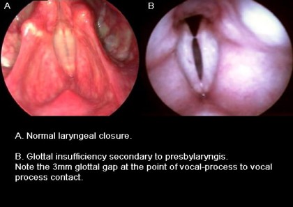 Presbylarynx UC Davis Center for Voice and SwallowingUC Davis